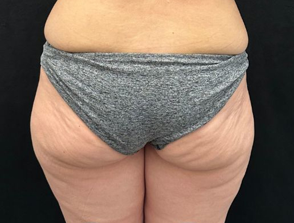 Brazilian Butt Lift Before & After