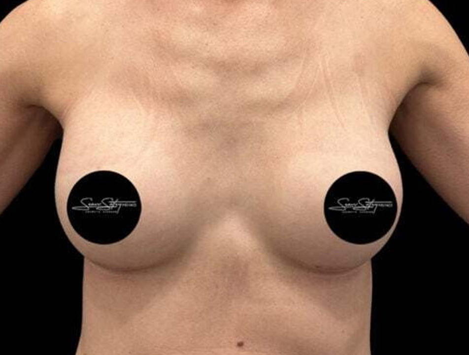 Breast Augmentation Before & After