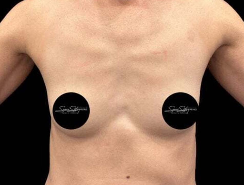 Breast Augmentation Before & After