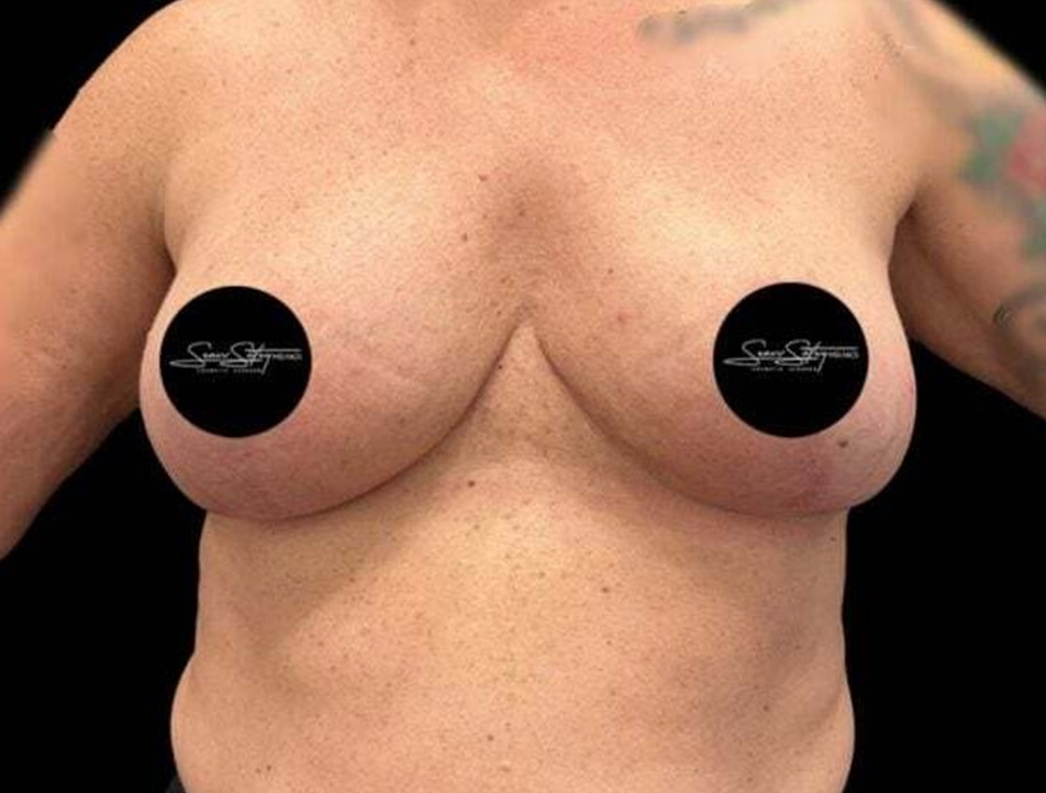 Breast Lift Before & After