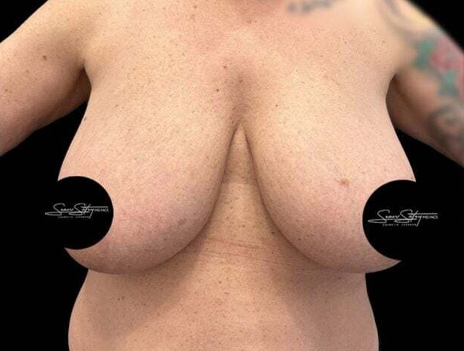 Breast Lift Before & After