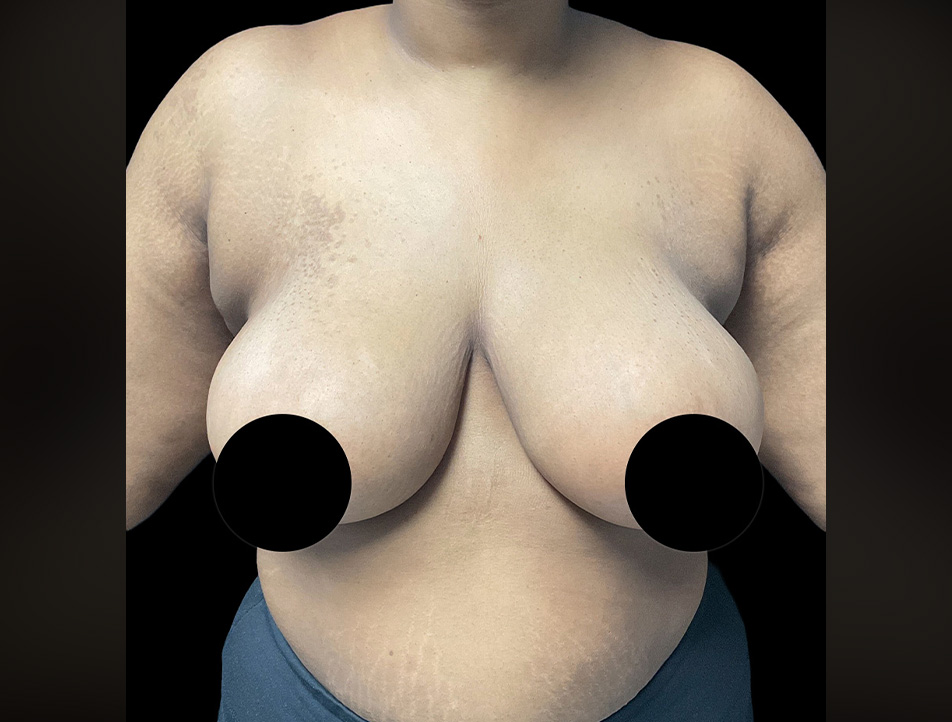 Breast Reduction Before & After