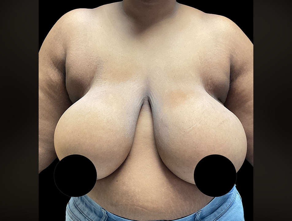 Breast Reduction Before & After
