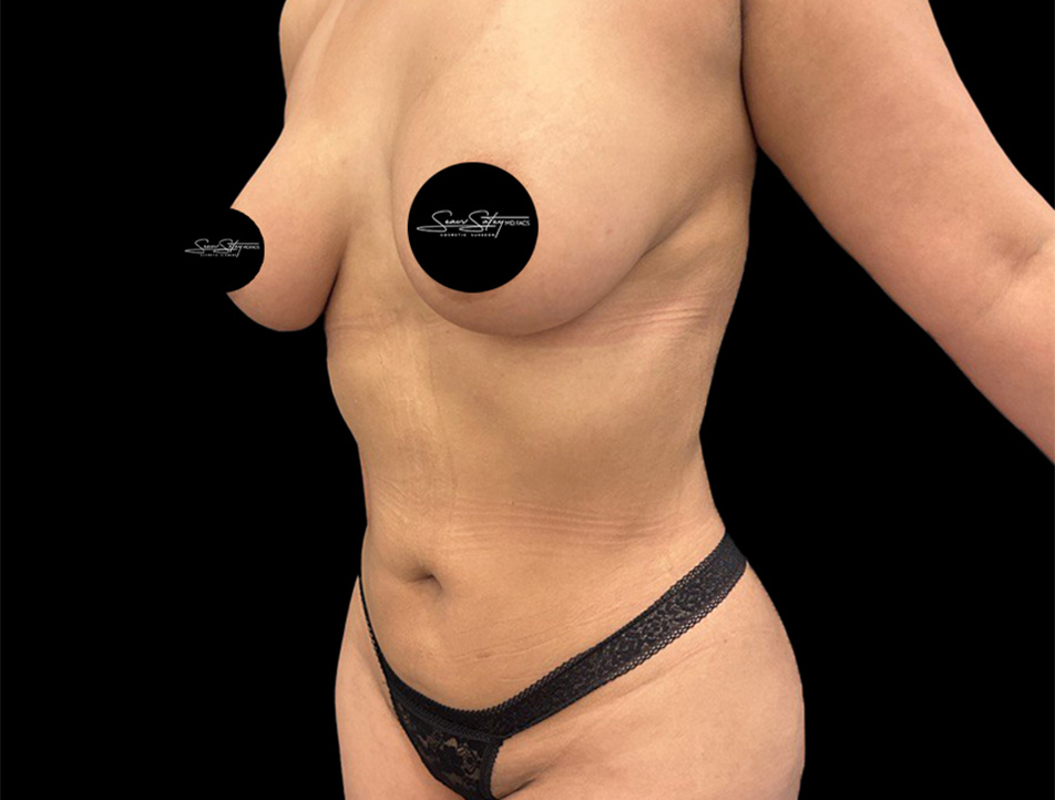 VASER Liposuction Before & After