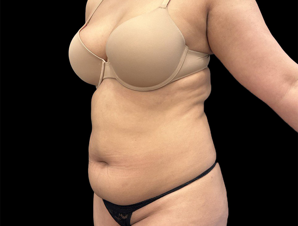 VASER Liposuction Before & After
