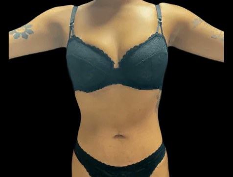 VASER Liposuction Before & After Patient #2614