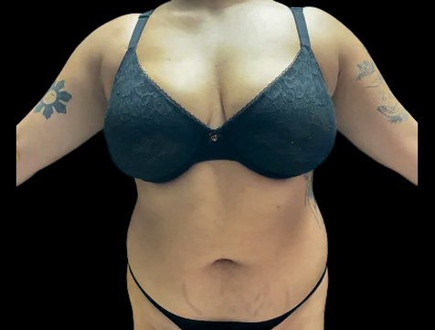 VASER Liposuction Before & After Patient #2614