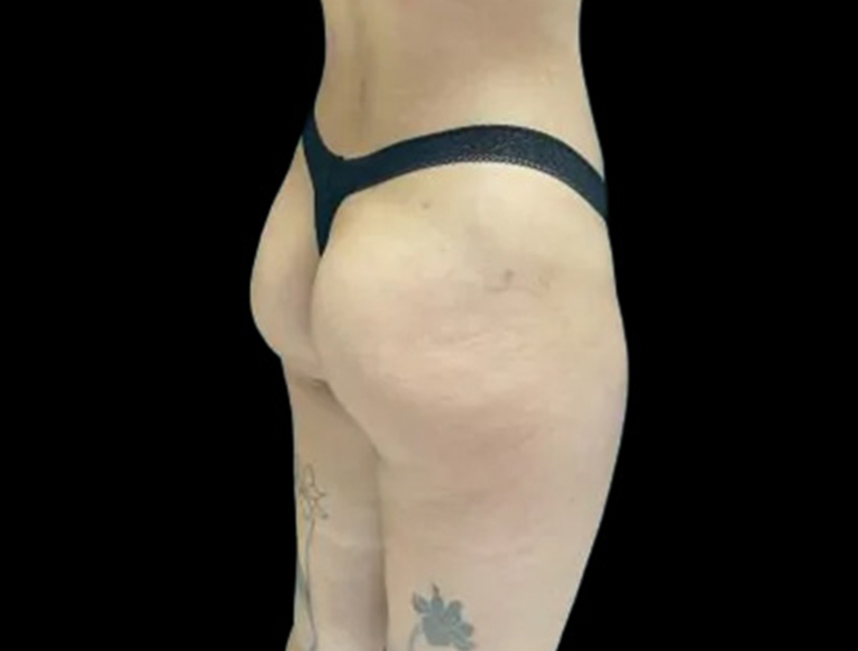 Sculptra Before & After