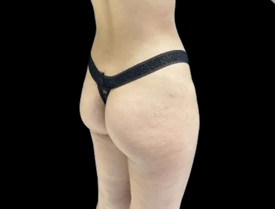 Sculptra Before & After