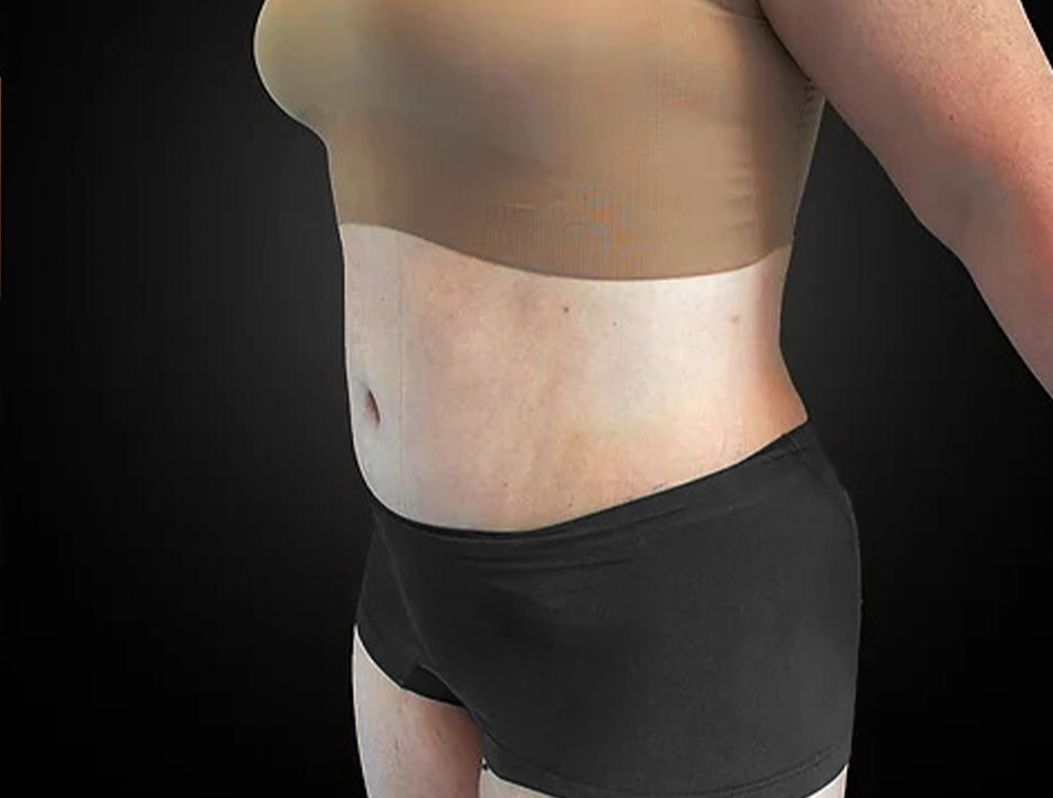 Tummy Tuck Before & After