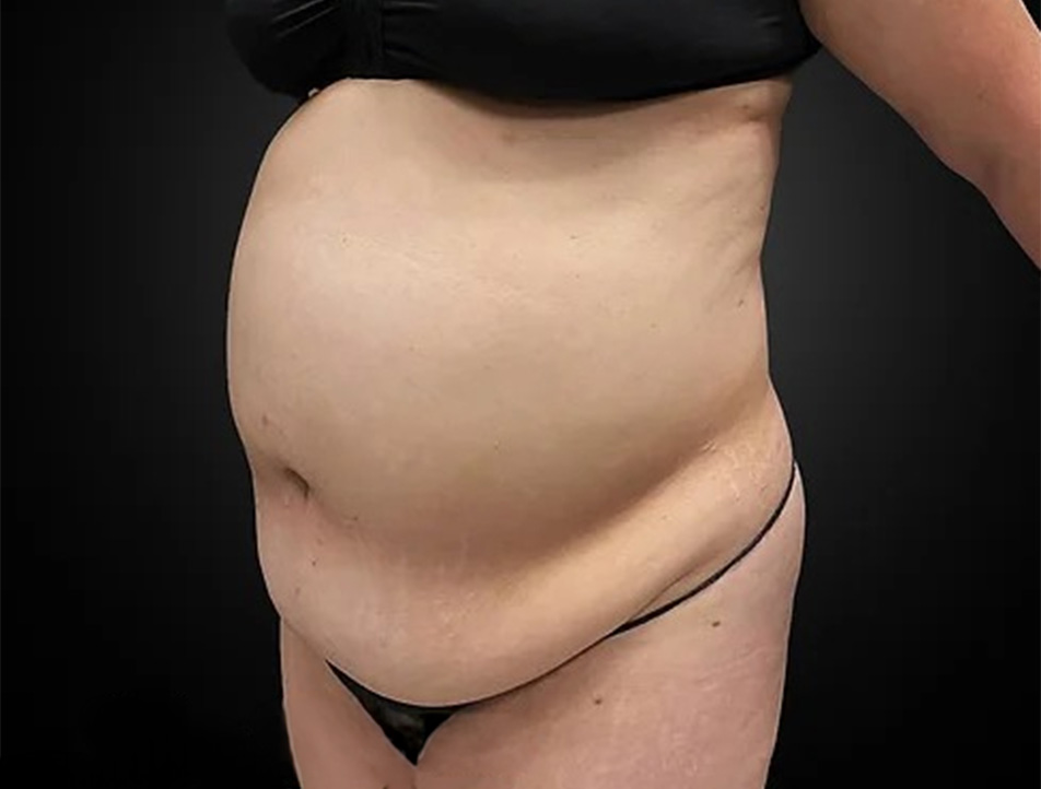 Tummy Tuck Before & After