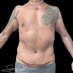 VASER Liposuction Before & After Patient #1015