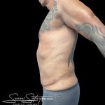 VASER Liposuction Before & After Patient #1015
