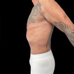 VASER Liposuction Before & After Patient #1015