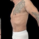 VASER Liposuction Before & After Patient #1015