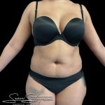 VASER Liposuction Before & After Patient #1016