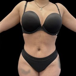 VASER Liposuction Before & After Patient #1016