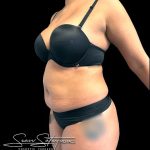 VASER Liposuction Before & After Patient #1016
