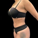 VASER Liposuction Before & After Patient #1016