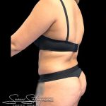 VASER Liposuction Before & After Patient #1016