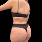 VASER Liposuction Before & After Patient #1016