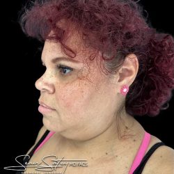 Neck Liposuction Before & After Patient #1017