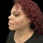Neck Liposuction Before & After Patient #1017