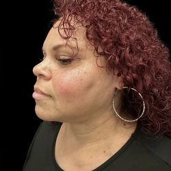 Neck Liposuction Before & After Patient #1017
