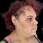 Neck Liposuction Before & After Patient #1017