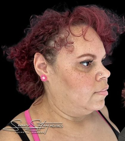 Neck Liposuction Before & After Patient #1017