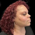 Neck Liposuction Before & After Patient #1017