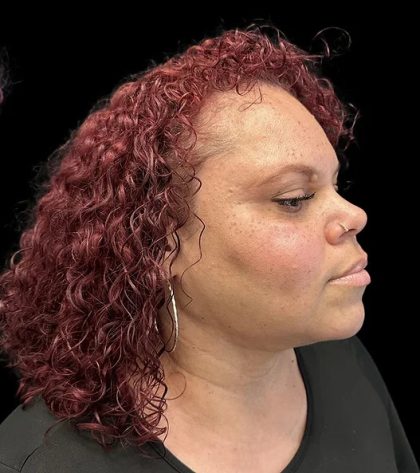 Neck Liposuction Before & After Patient #1017