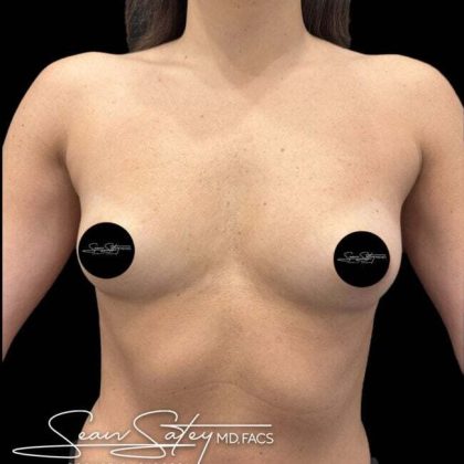 Breast Augmentation Before & After Patient #1018