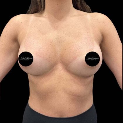 Breast Augmentation Before & After Patient #1018