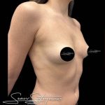Breast Augmentation Before & After Patient #1018