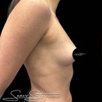 Breast Augmentation Before & After Patient #1018