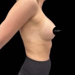 Breast Augmentation Before & After Patient #1018