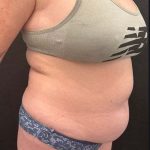 VASER Liposuction Before & After Patient #1013