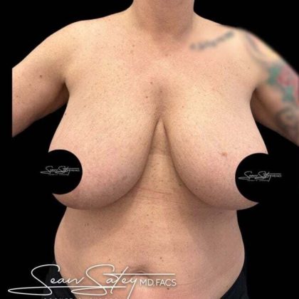 Breast Lift Before & After Patient #1020