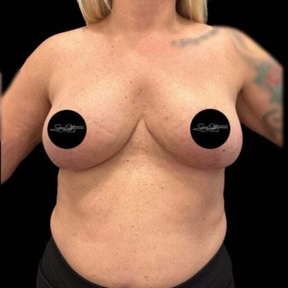 Breast Lift Before & After Patient #1020