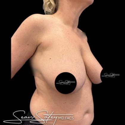 Breast Lift Before & After Patient #1020