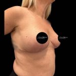 Breast Lift Before & After Patient #1020