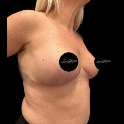 Breast Lift Before & After Patient #1020