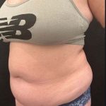 VASER Liposuction Before & After Patient #1013