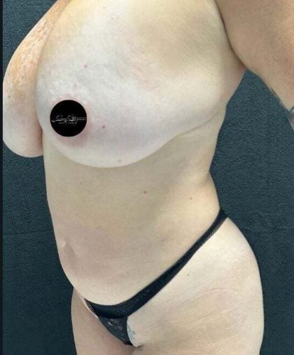 VASER Liposuction Before & After Patient #1013