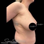 Breast Lift Before & After Patient #1020