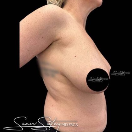 Breast Lift Before & After Patient #1020