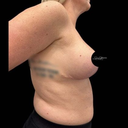 Breast Lift Before & After Patient #1020