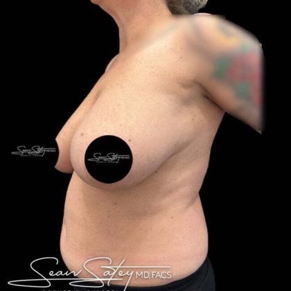 Breast Lift Before & After Patient #1020