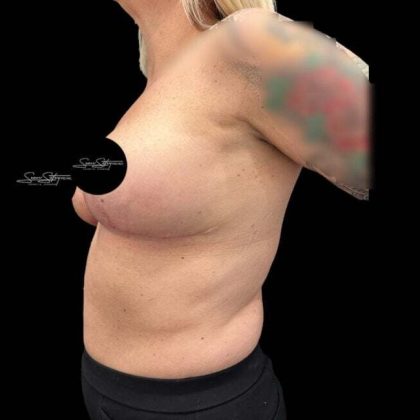 Breast Lift Before & After Patient #1020